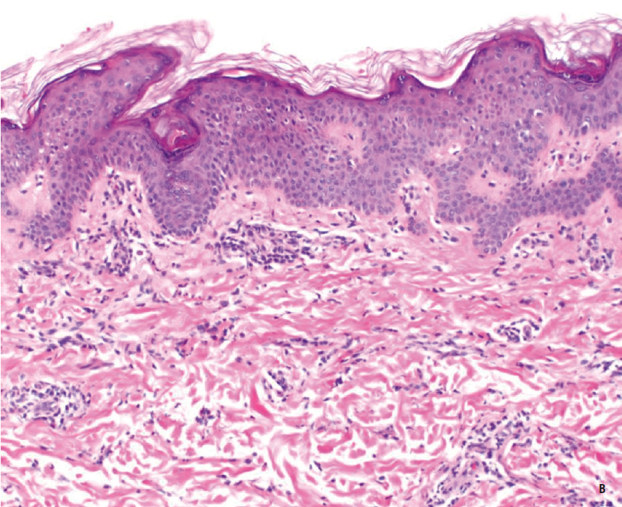 Systemic Onset Juvenile Idiopathic Arthritis Consultant360